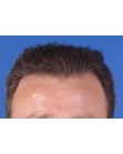 After Hair Transplant  Front
